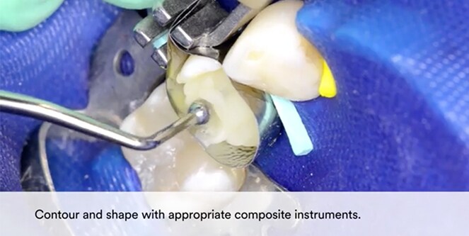 still from Clinical case using 3M™ RelyX™ Fiber Post 3D, 3M™ RelyX™ Unicem 2, 3M™ Filtek™ Bulk Fill Posterior and 3M™ Scotchbond™ Universal video
