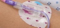 Catheter Securement Systems
