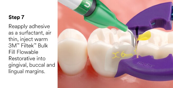 Bioclear posterior restoration video screenshot
