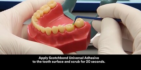 still from Cementation of a lithium disilicate crown with 3M ™ RelyX ™ Ultimate Automix Cement video

