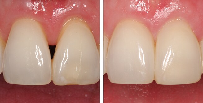 two front teeth with a gap shaped like black triangles on the left compared to the same teeth post-restoration on the right, where the gap has been filled in
