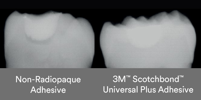 Comparison of non-radiopaque adhesive shadow and radiopaque Scotchbond Universal Plus Adhesive

