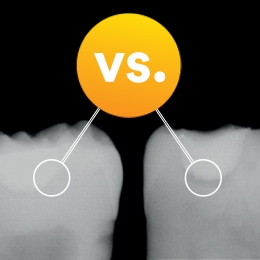 radiopaque (left) vs. radiolucent (right) dental adhesive comparison