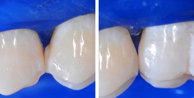 posterior teeth with blocky, sharp-angled contacts on the left compared to smooth, naturally curved contacts on the right
