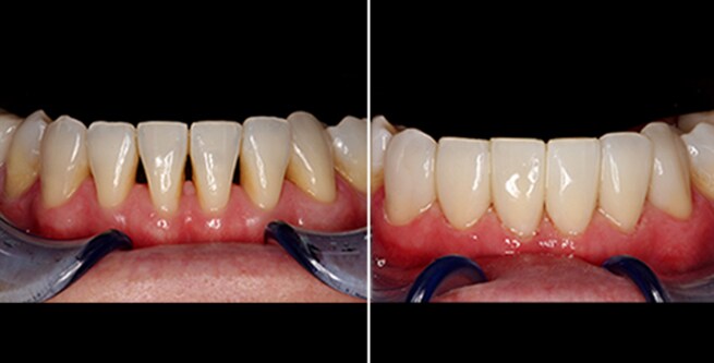 side-by-side comparison of teeth with black triangle gaps before restoration, and without gaps after restoration
