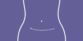 PREVENA RESTOR BELLA•FORM™ Incision Management System
